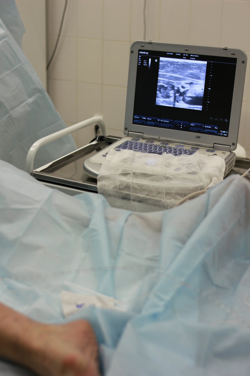 Máquina de ultrasonido con transductor sobre teclado cerca de la pierna del paciente.